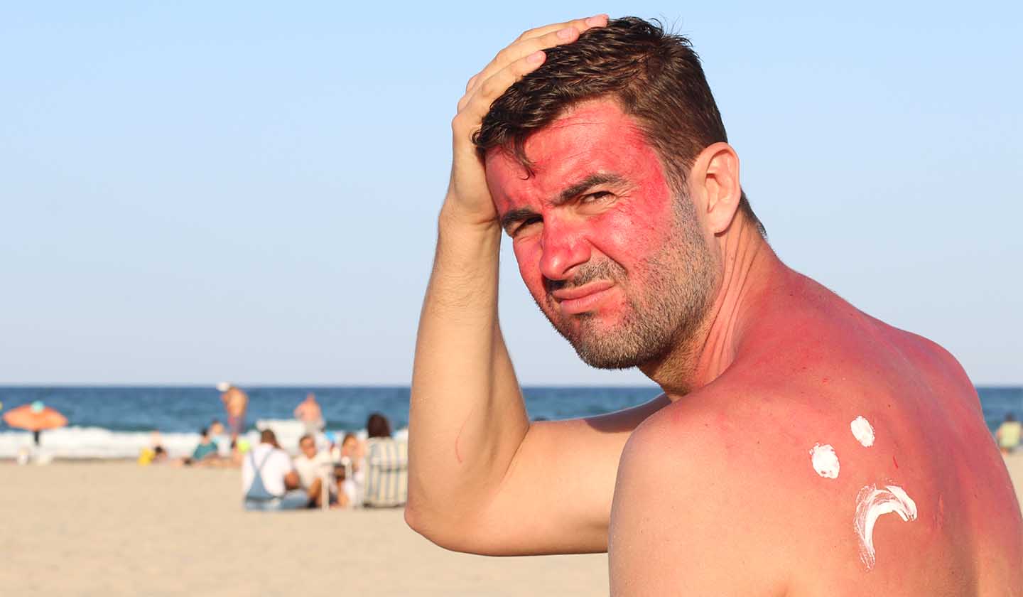 Excessive sun exposure on the beach