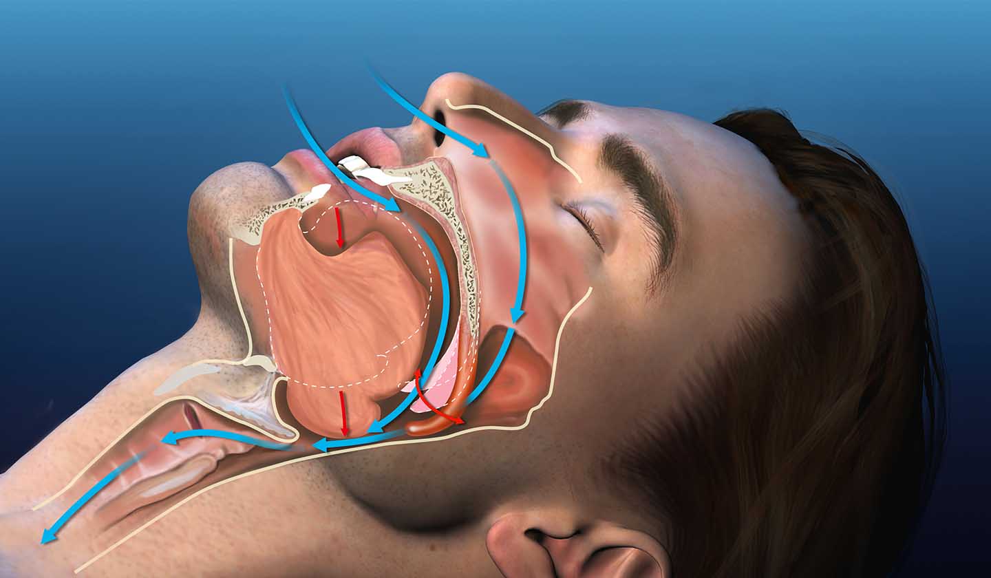 Factors which aggravate snoring