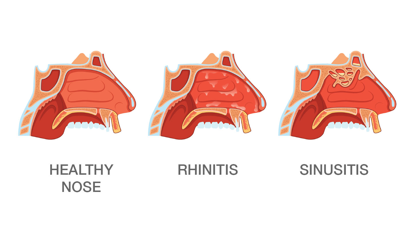 Rhinitis on sale