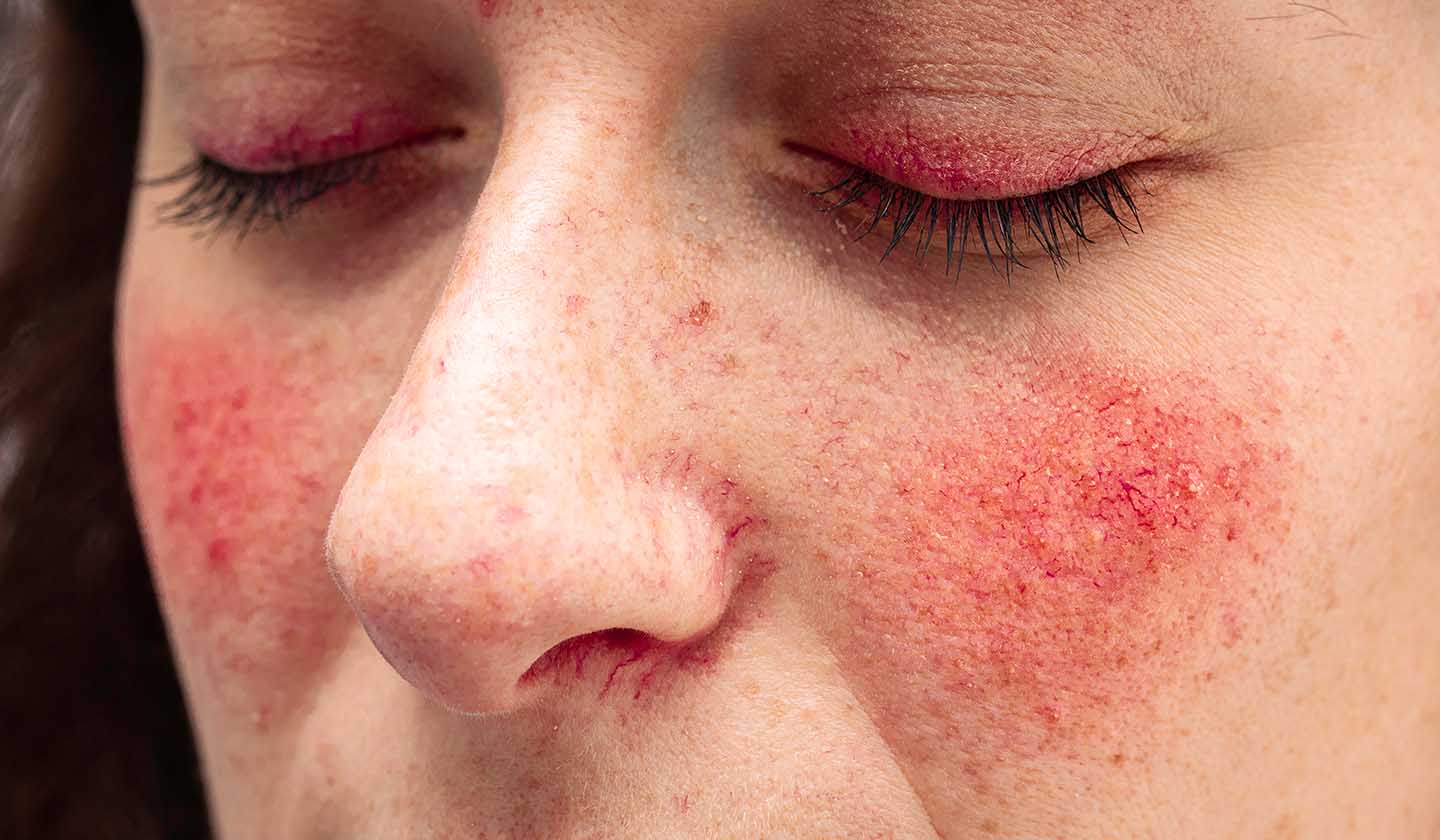 Rosacea strokes