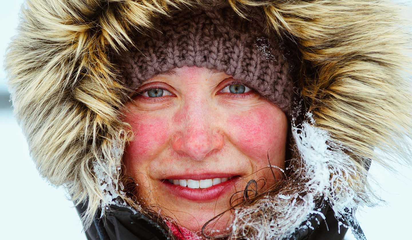 Cold and wind are related to rosacea