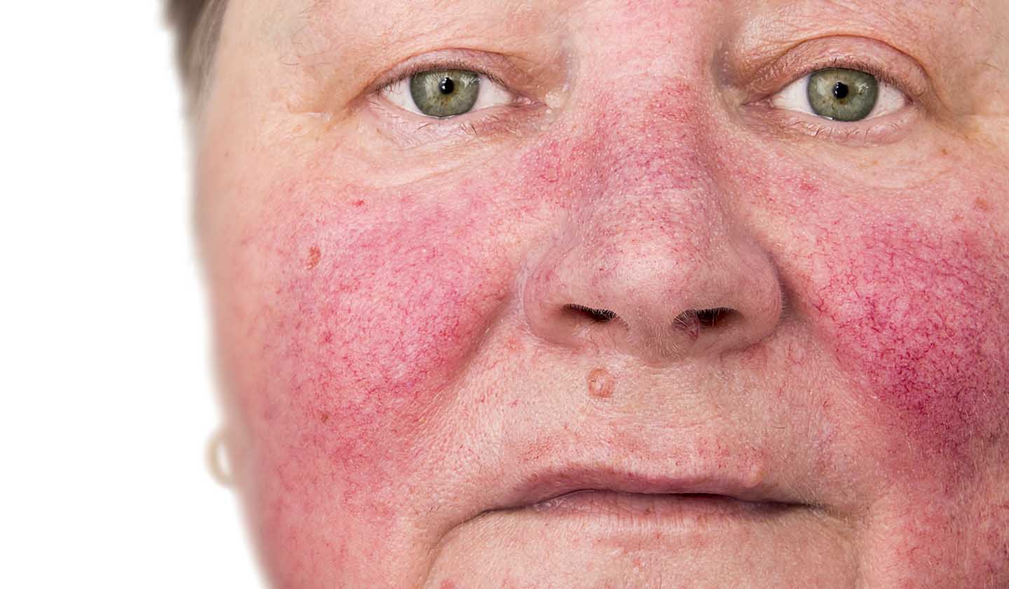 Subtype I, erythematous-telangiectatic rosacea