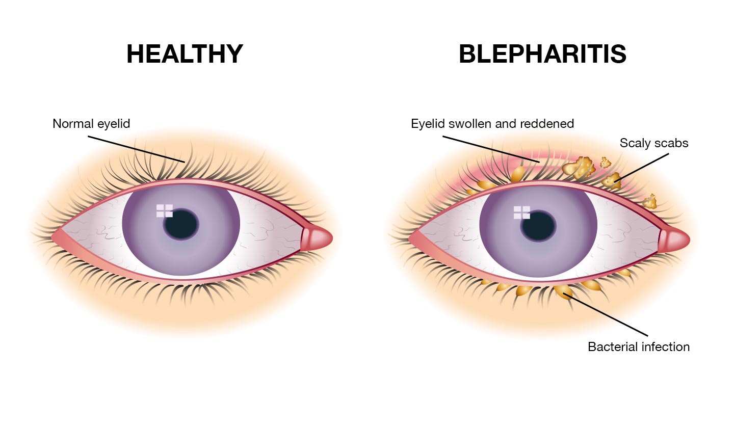 Symptoms of blepharitis