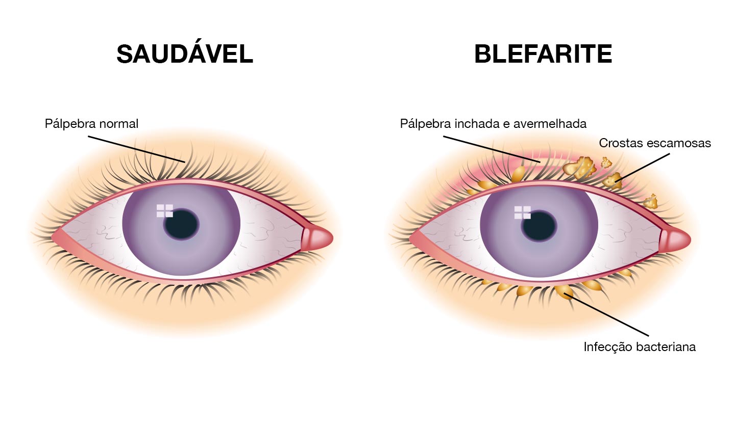 Sintomas da blefarite