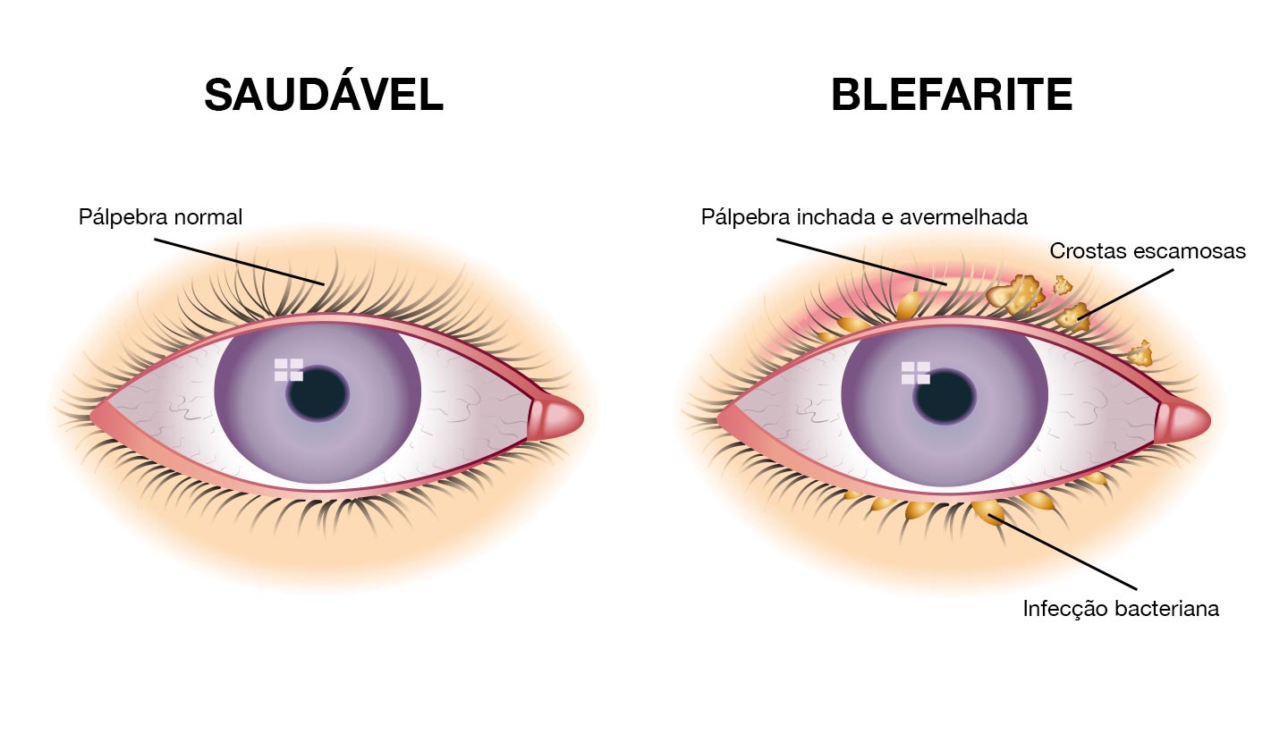Epibléfaro: o que é, sintomas e tratamento