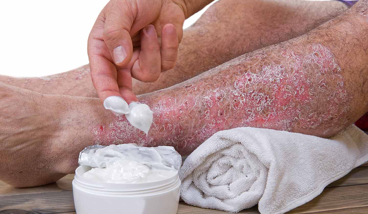 Psoriasisis - treatment