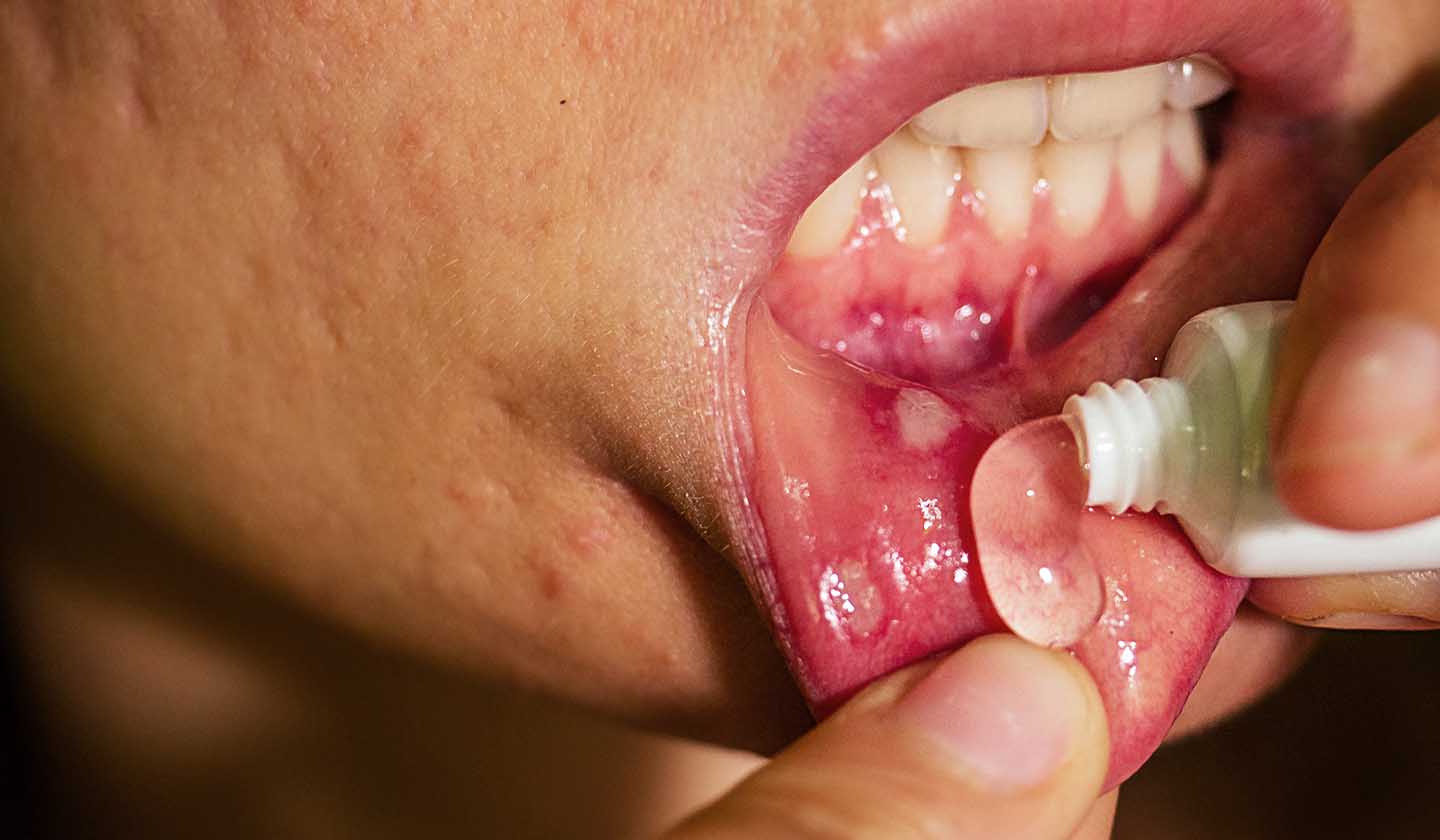 Gel for canker sores