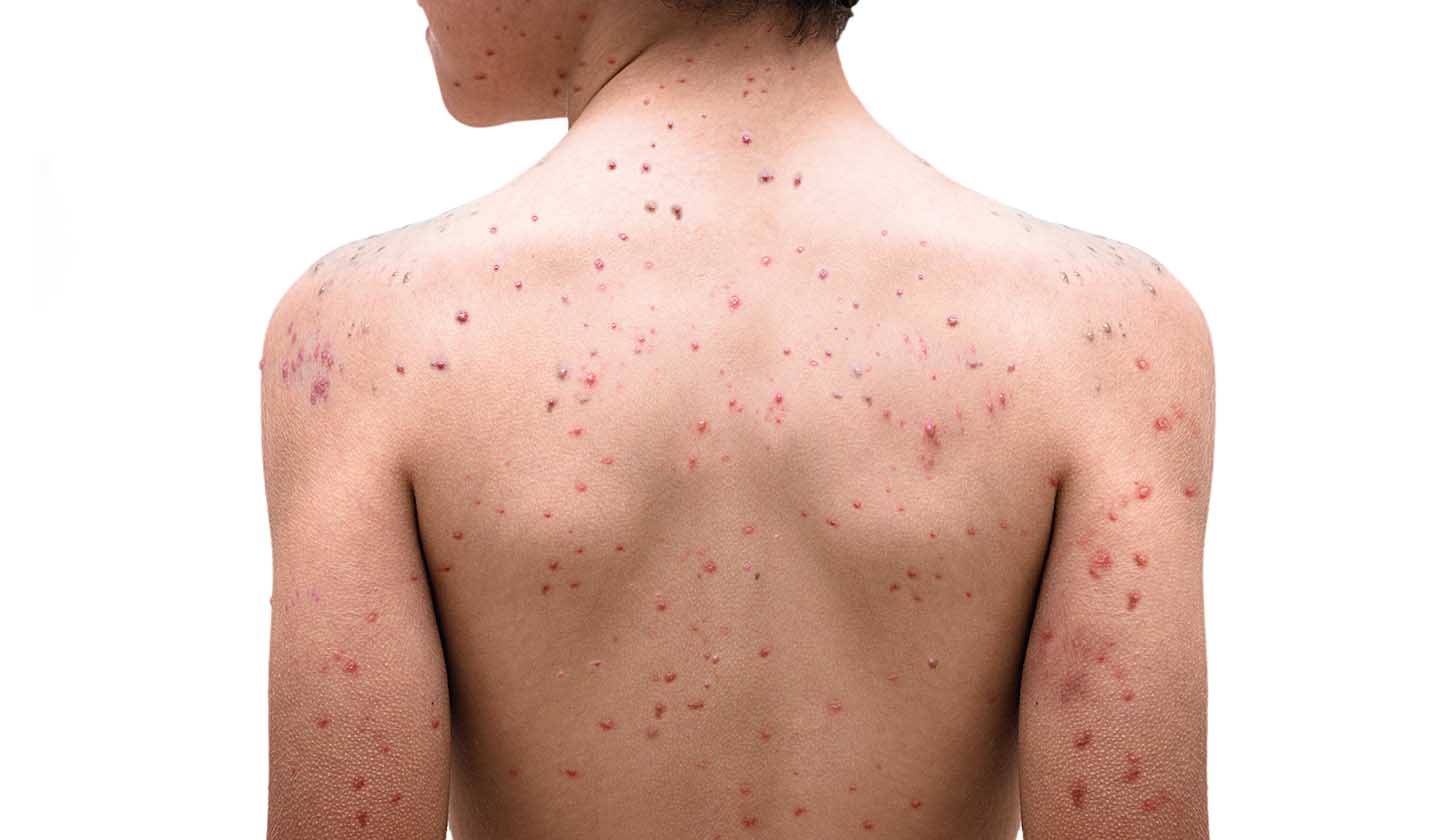 Chickenpox skin rashes