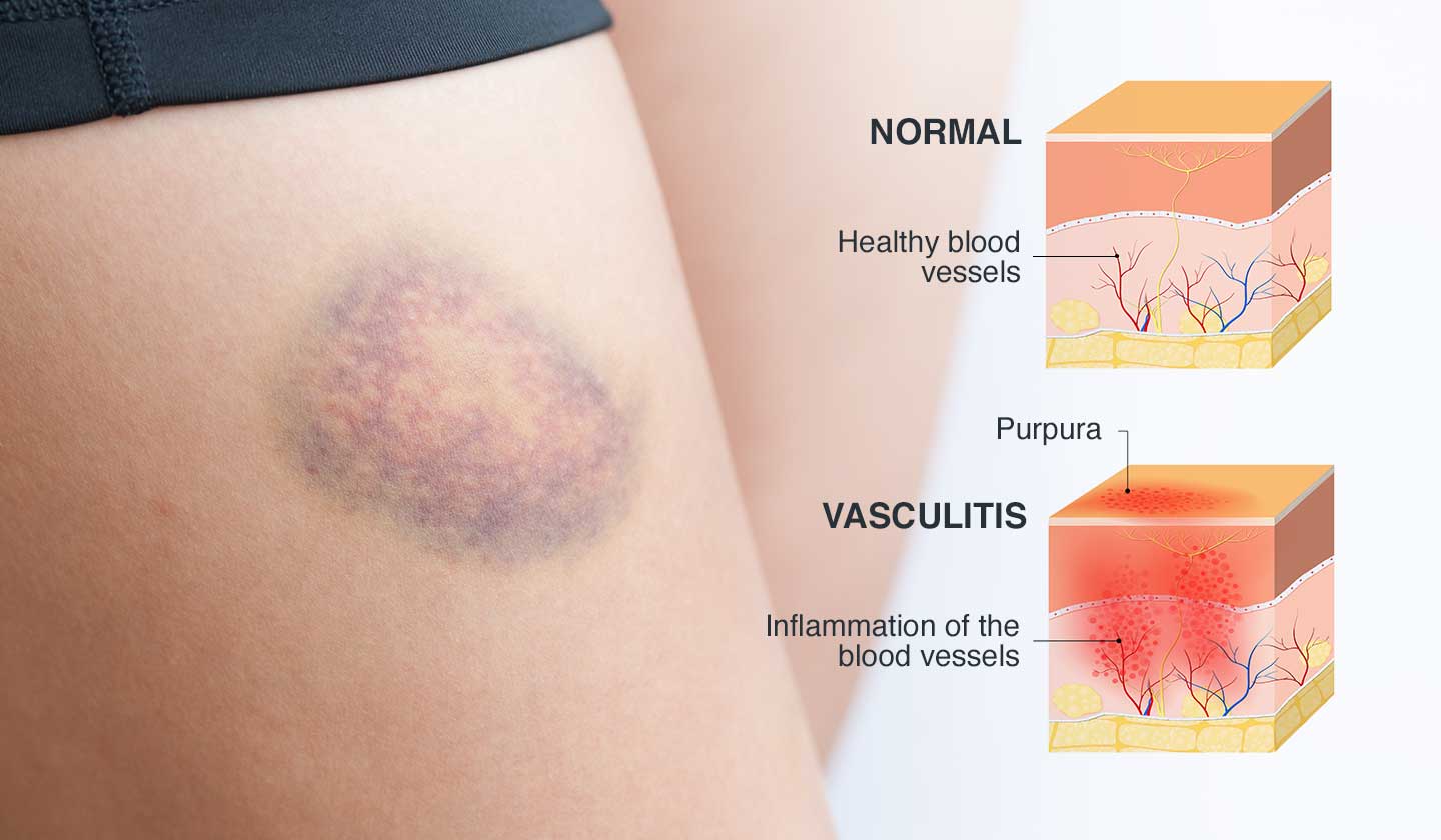 Haematomas - Symptoms