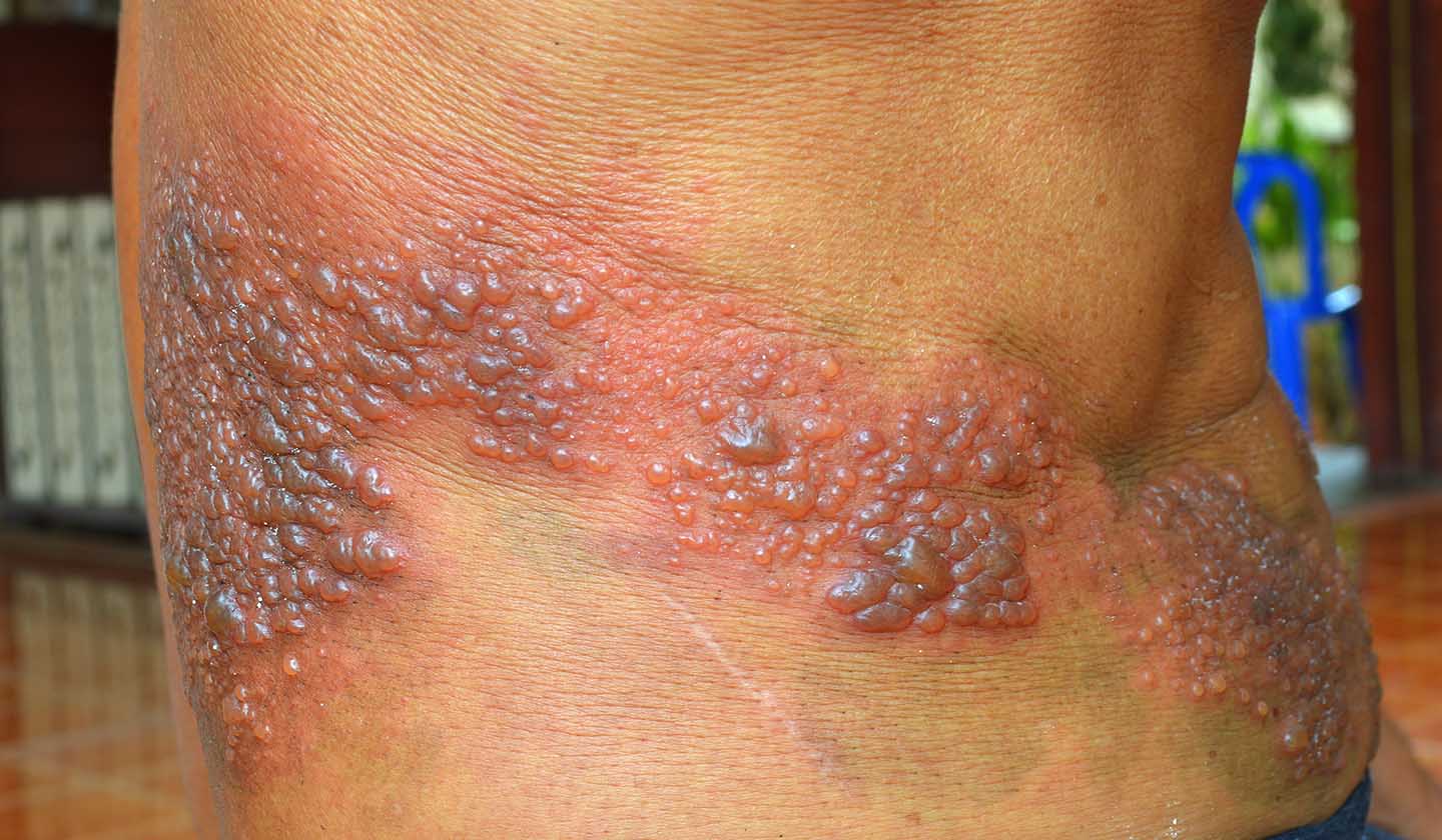 Adult with advanced status of Zona or Herpes Zoster